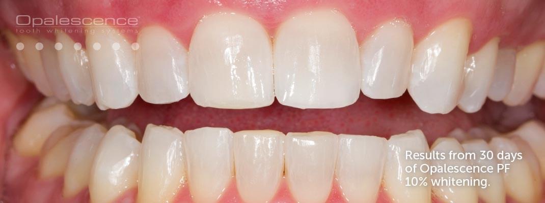 After Opalescence tooth whitening system